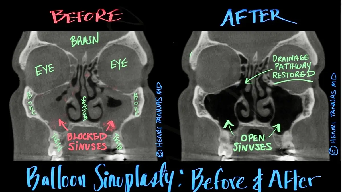 before-after-sinus-ct-scans-balloon-sinuplasty-chronic-sinusitis-relief-dallas-tx DESKTOP