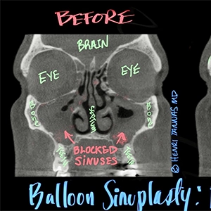 balloon-sinuplasty-before-after-ct-scans-Dallas