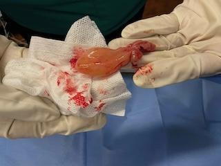 large-nasal-polyp-removed-at-walnut-hill-ent-by-dr-tannas