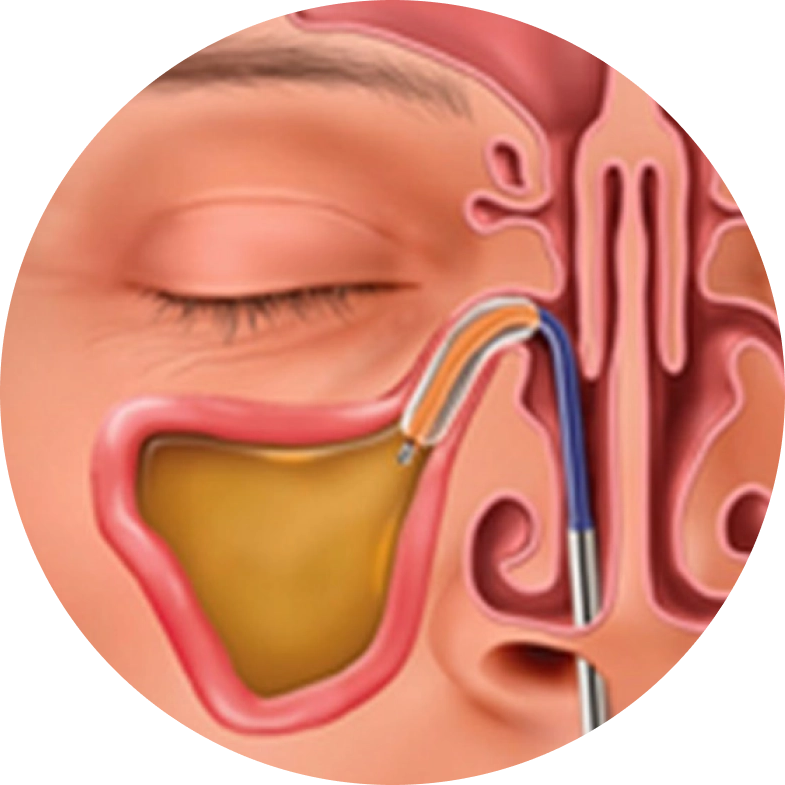 balloon-sinuplasty