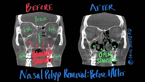 Nasal Polyp Removal Sinus CT Scans in Dallas